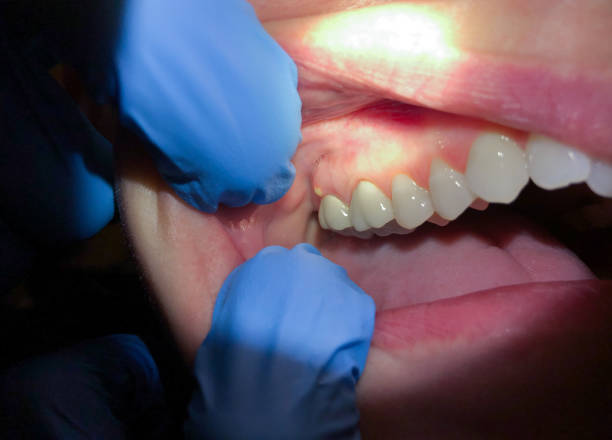 Best Emergency Treatment for Oral Infections in Massanutten, VA