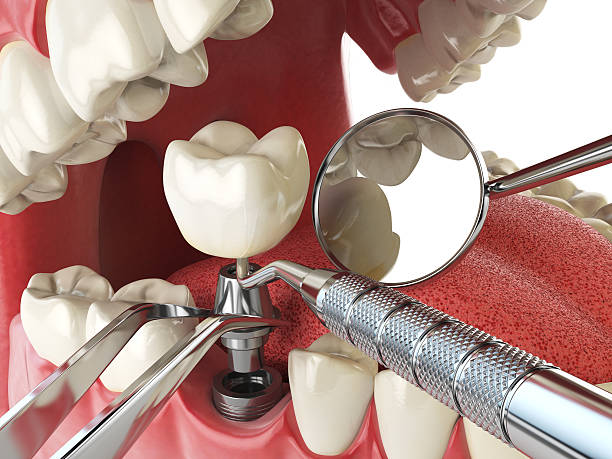 Best Emergency Denture Repair in Massanutten, VA